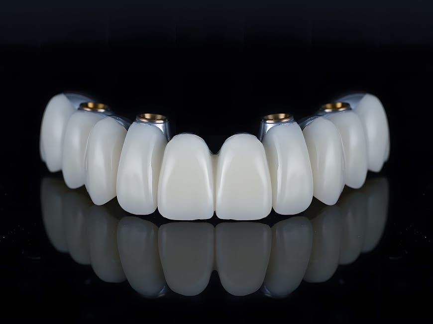 How All-on-X full-arch dental implants work — 4 to 6 implants per arch