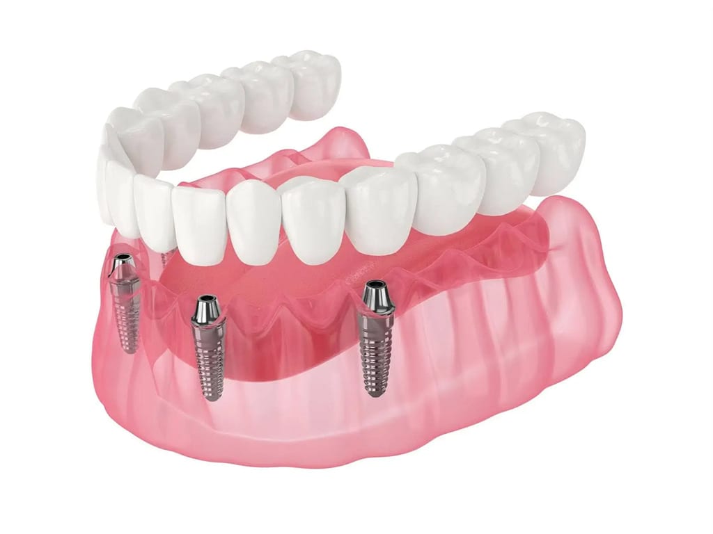 Full arch (same-day full-mouth)