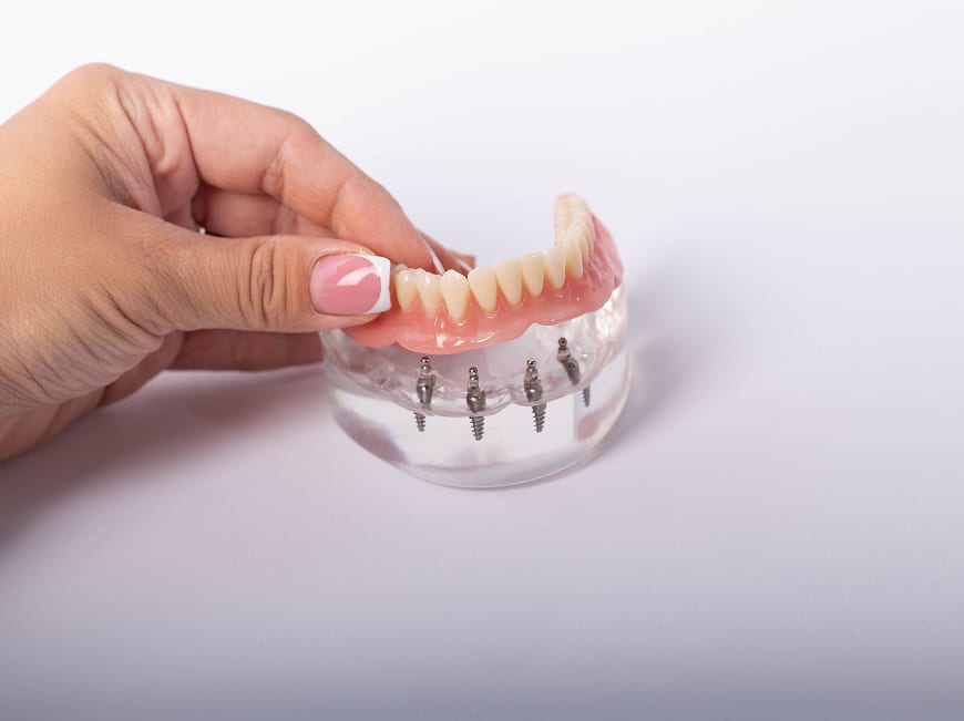 CBCT bone assessment for implant-supported dentures