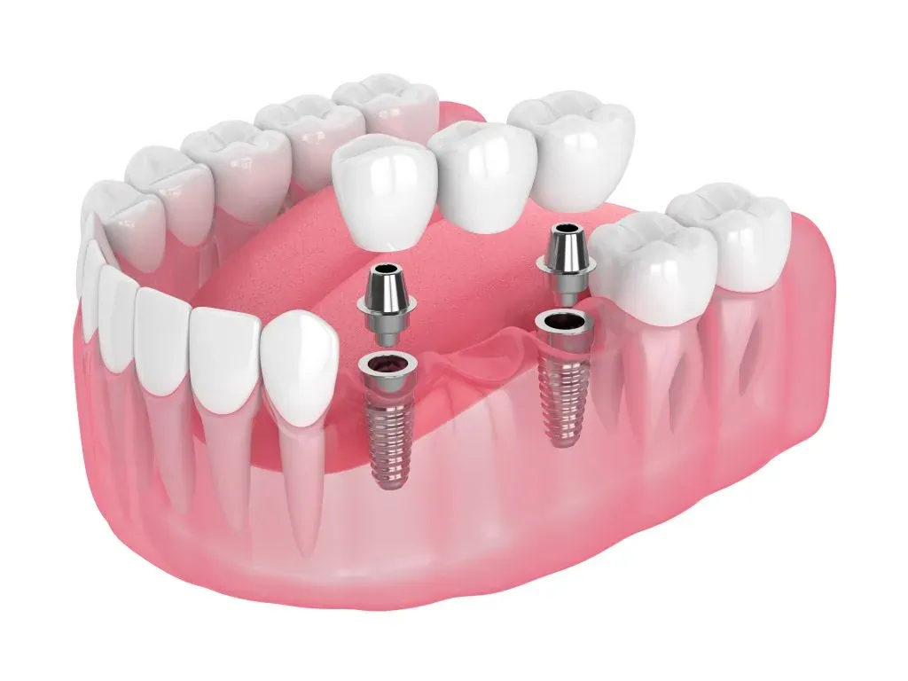Multiple teeth / partial arch
