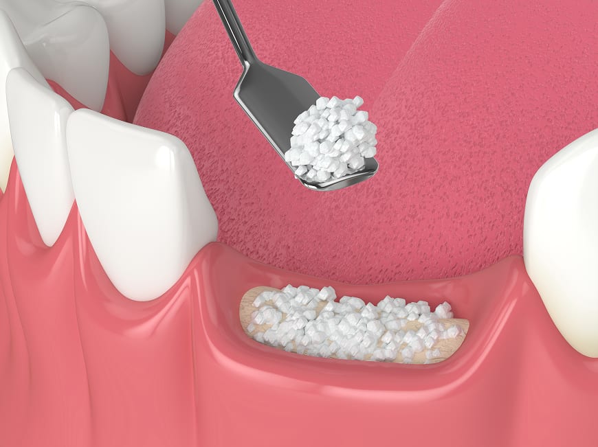 Ridge augmentation techniques — guided bone regeneration and block grafting for narrow jaw ridges