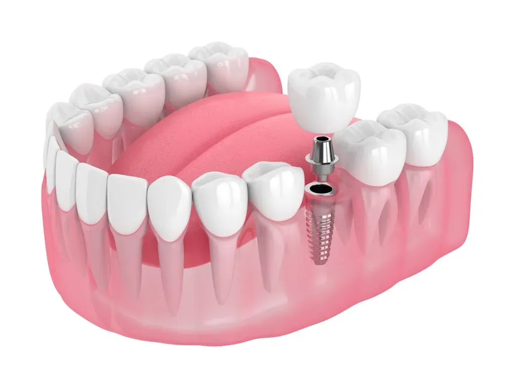 Single tooth