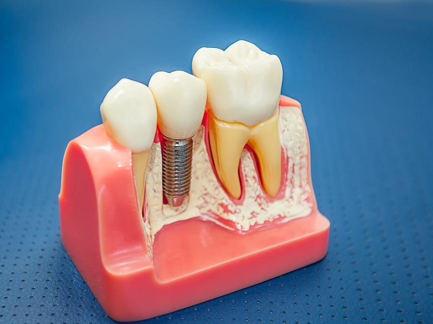 Three components of a single tooth implant — fixture, abutment, crown